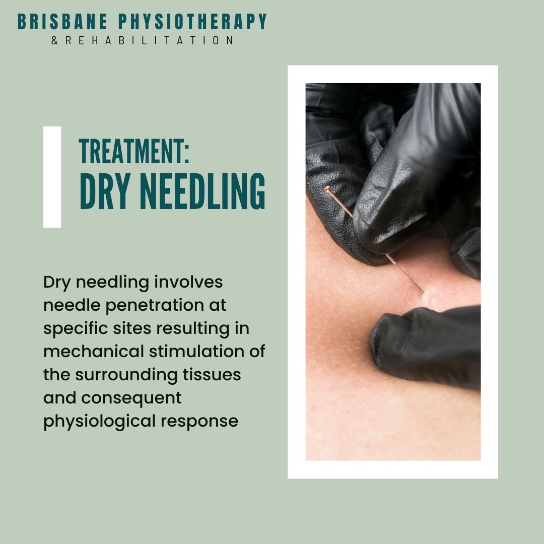 We offer dry needling