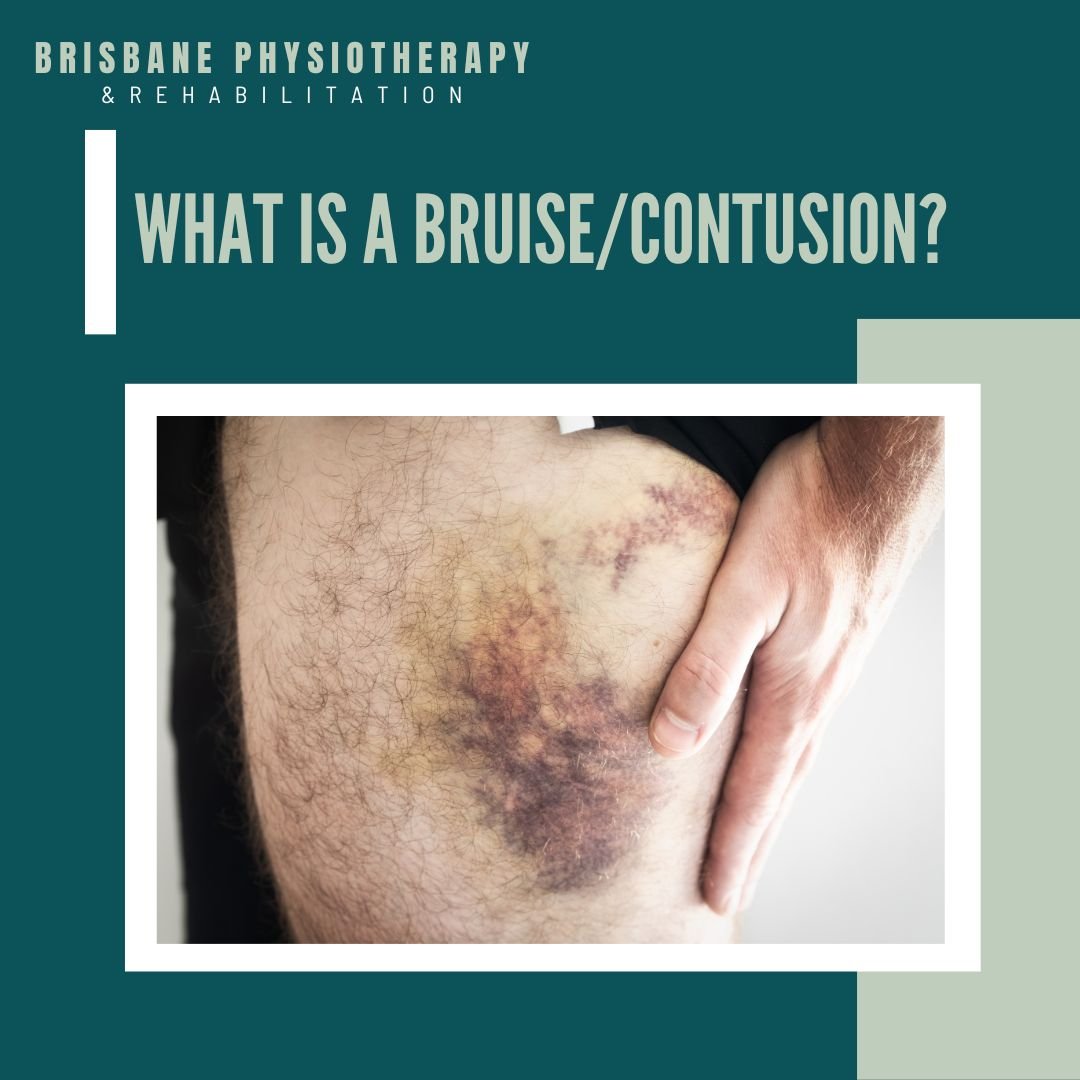 Bruises & Contusions