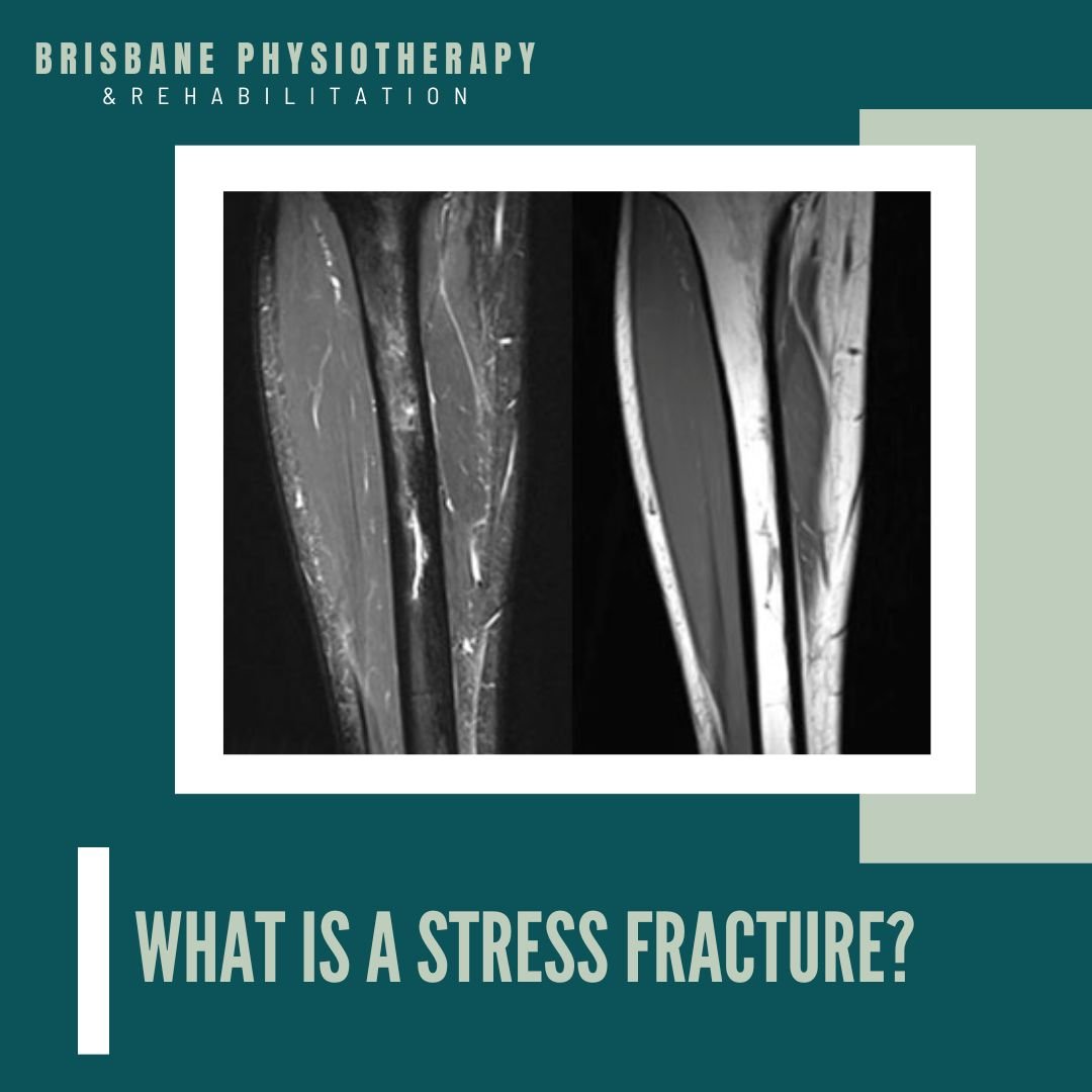 What is a Stress Fracture? And what are the Physiotherapy Benefits?