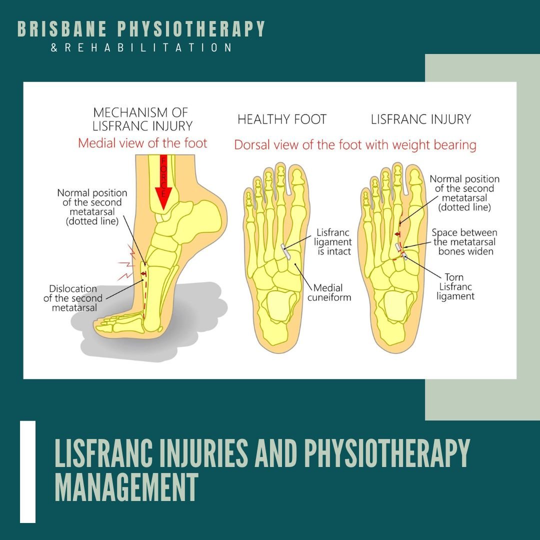 Lisfranc Injuries and Physiotherapy Management