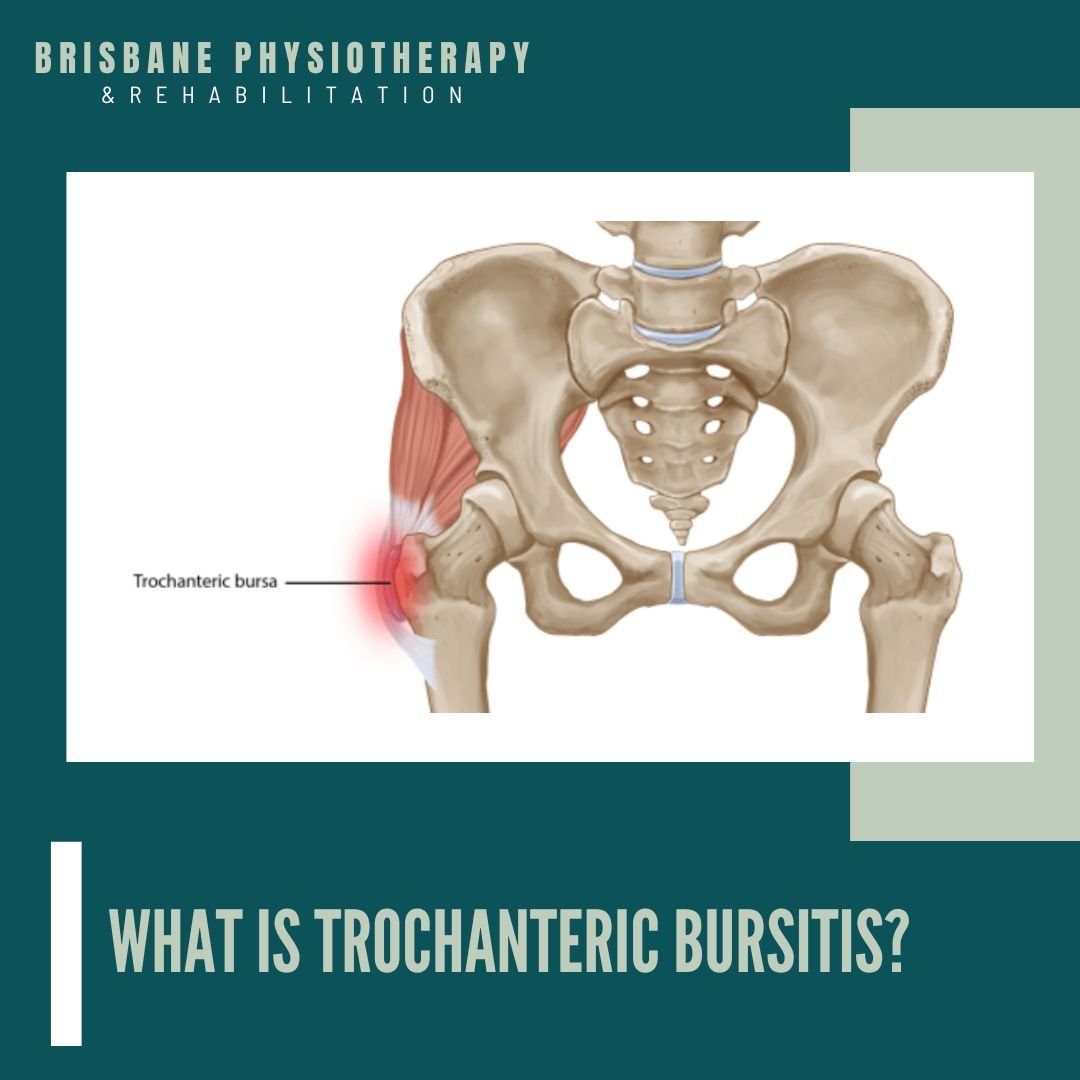 What is Trochanteric Bursitis? - Brisbane Physiotherapy
