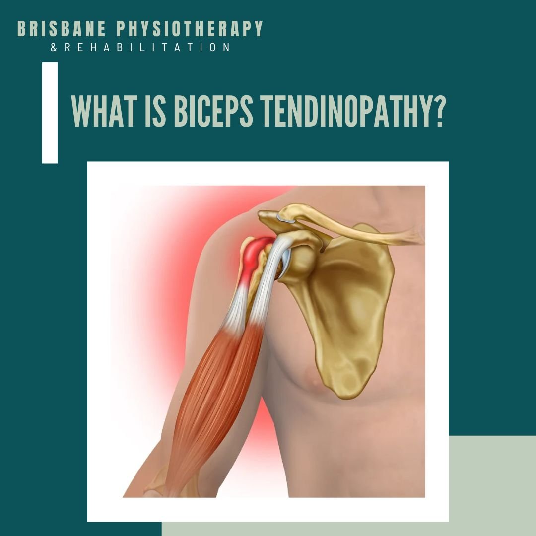What is Biceps Tendinopathy?