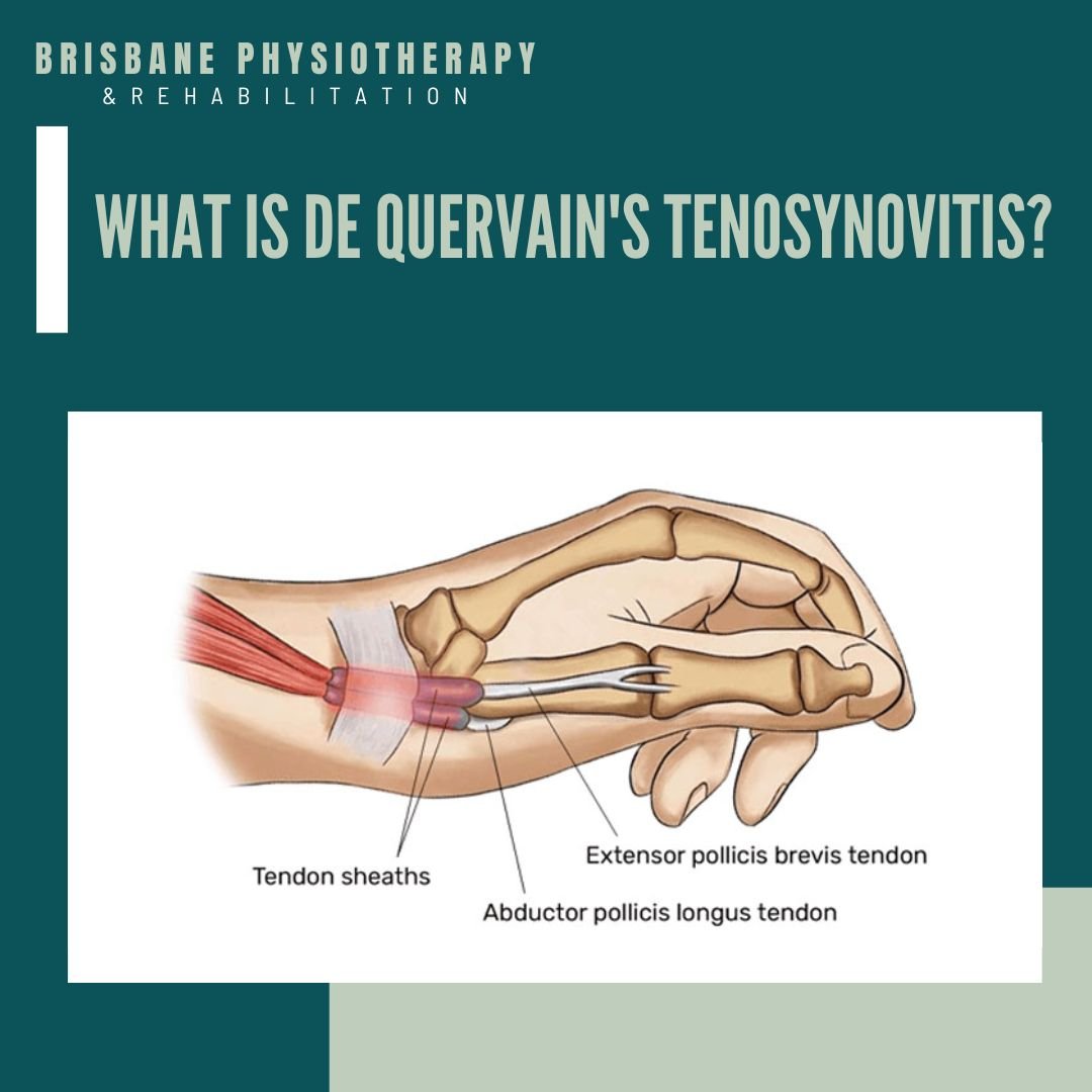 What is De Quervain's Tenosynovitis?