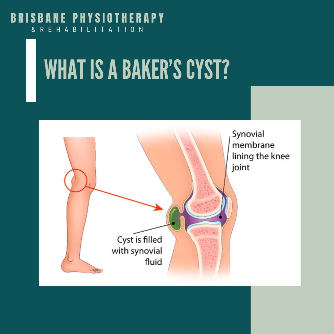 Baker’s Cysts