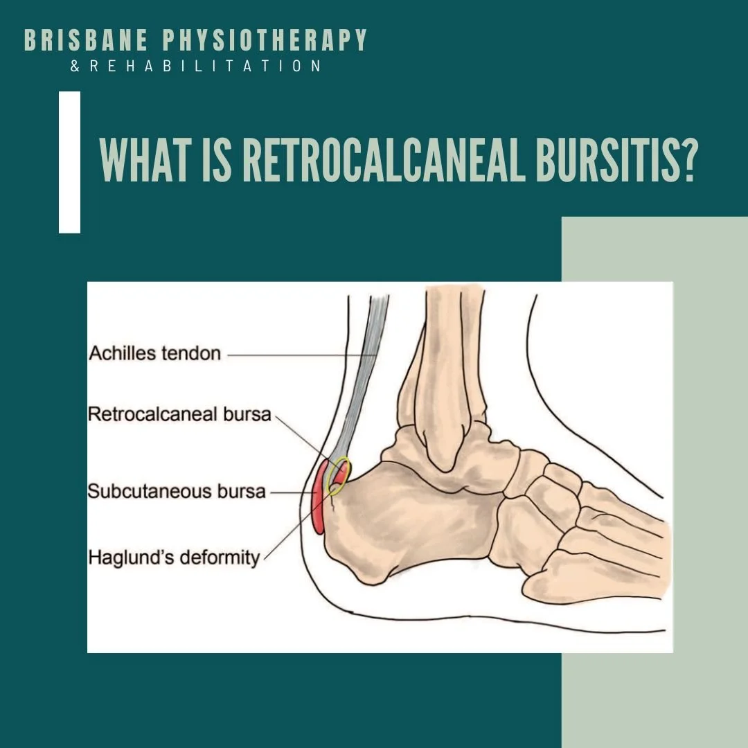 Retrocalcaneal Bursitis