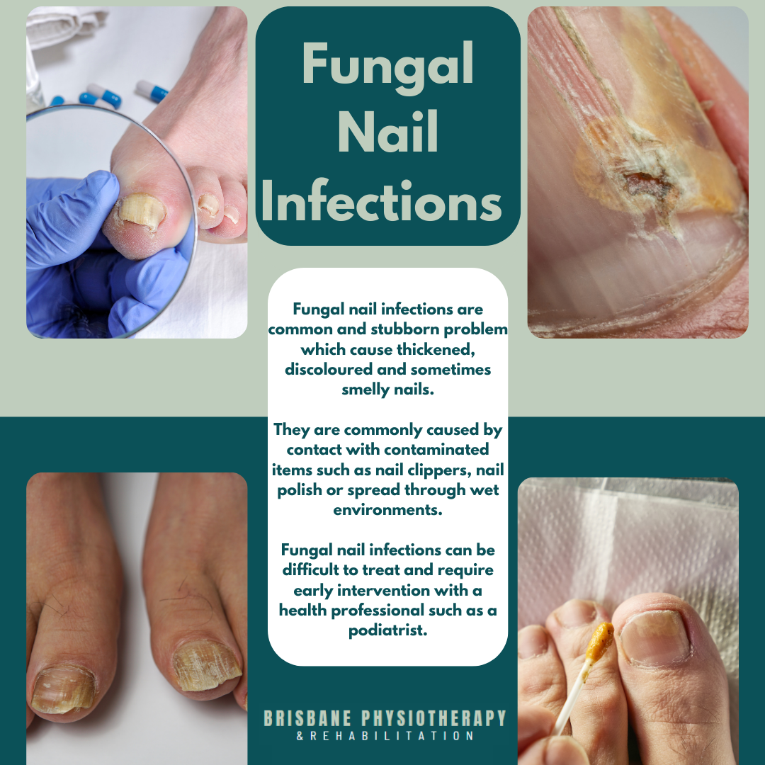 Fungal Nail Infection Onychomycosis Causes Symptoms Podiatry 