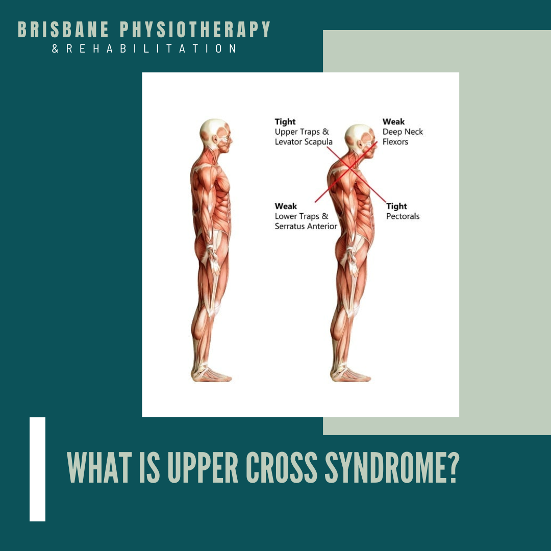 What is Upper Cross Syndrome?