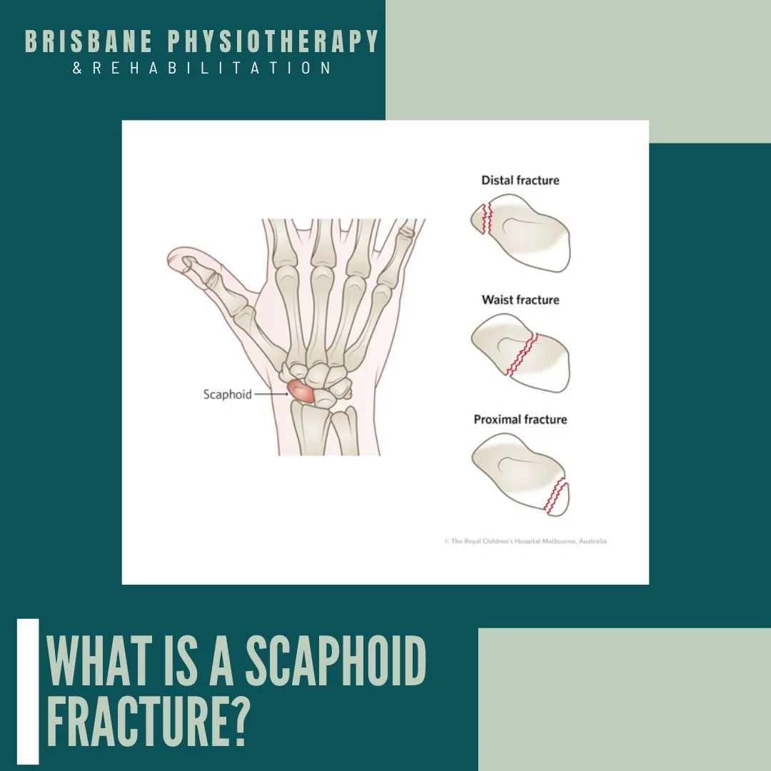 What is a Scaphoid Fracture?