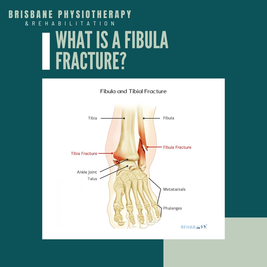 What is a Fibula Fracture?