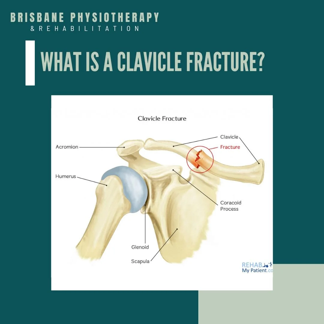 What is a Clavicle Fracture?