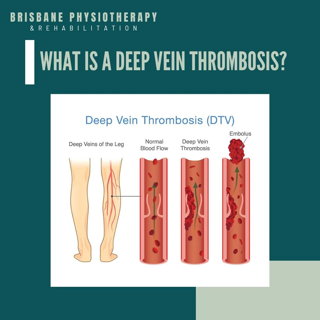 What is Deep Vein Thrombosis (DVT)?