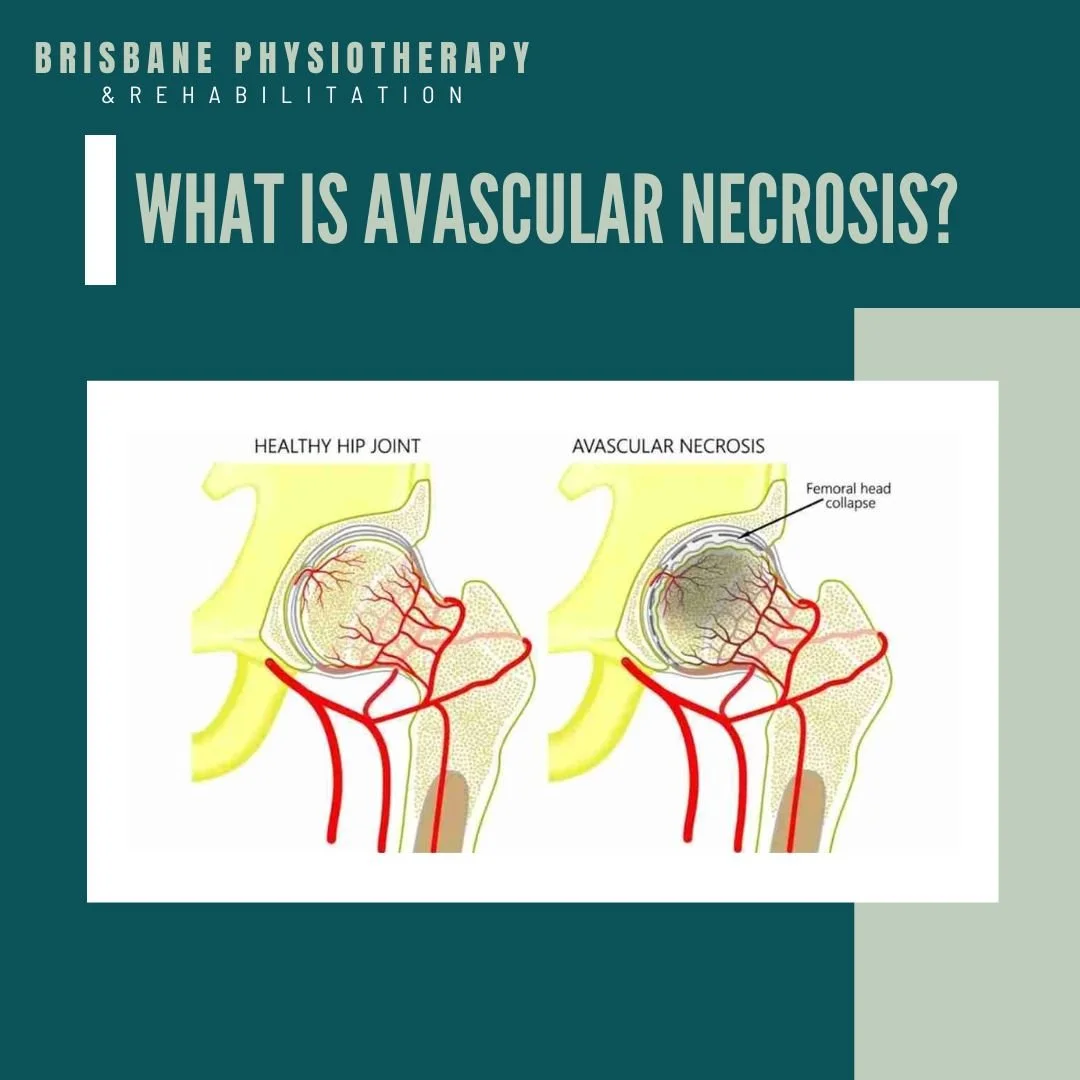 What is Avascular Necrosis?