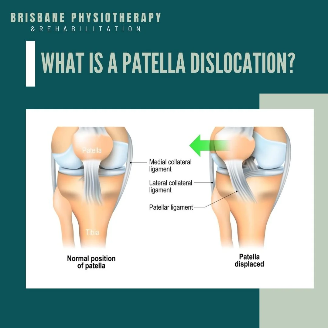 Patella Dislocation Treatment