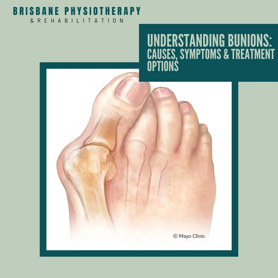 What Are Bunions?