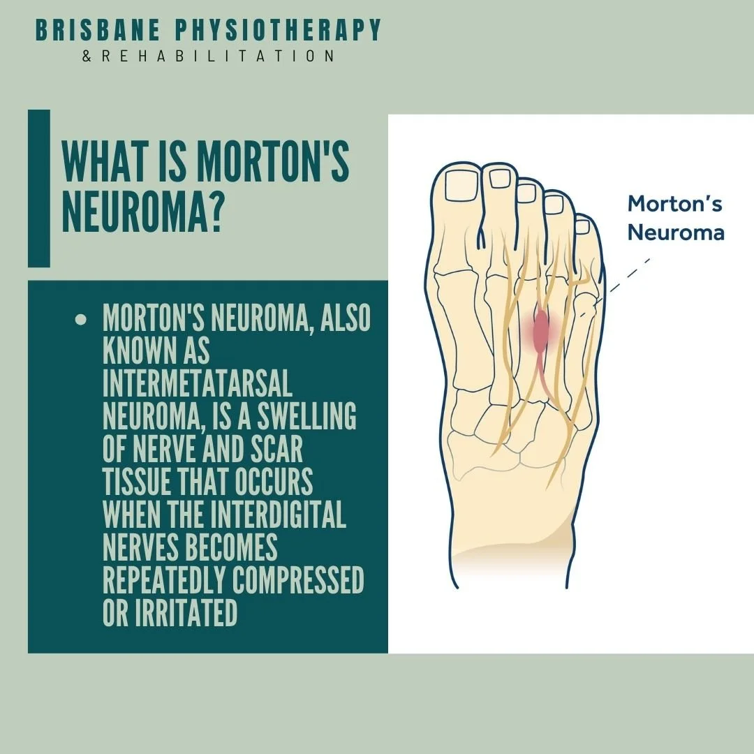 What Is Morton’s Neuroma?