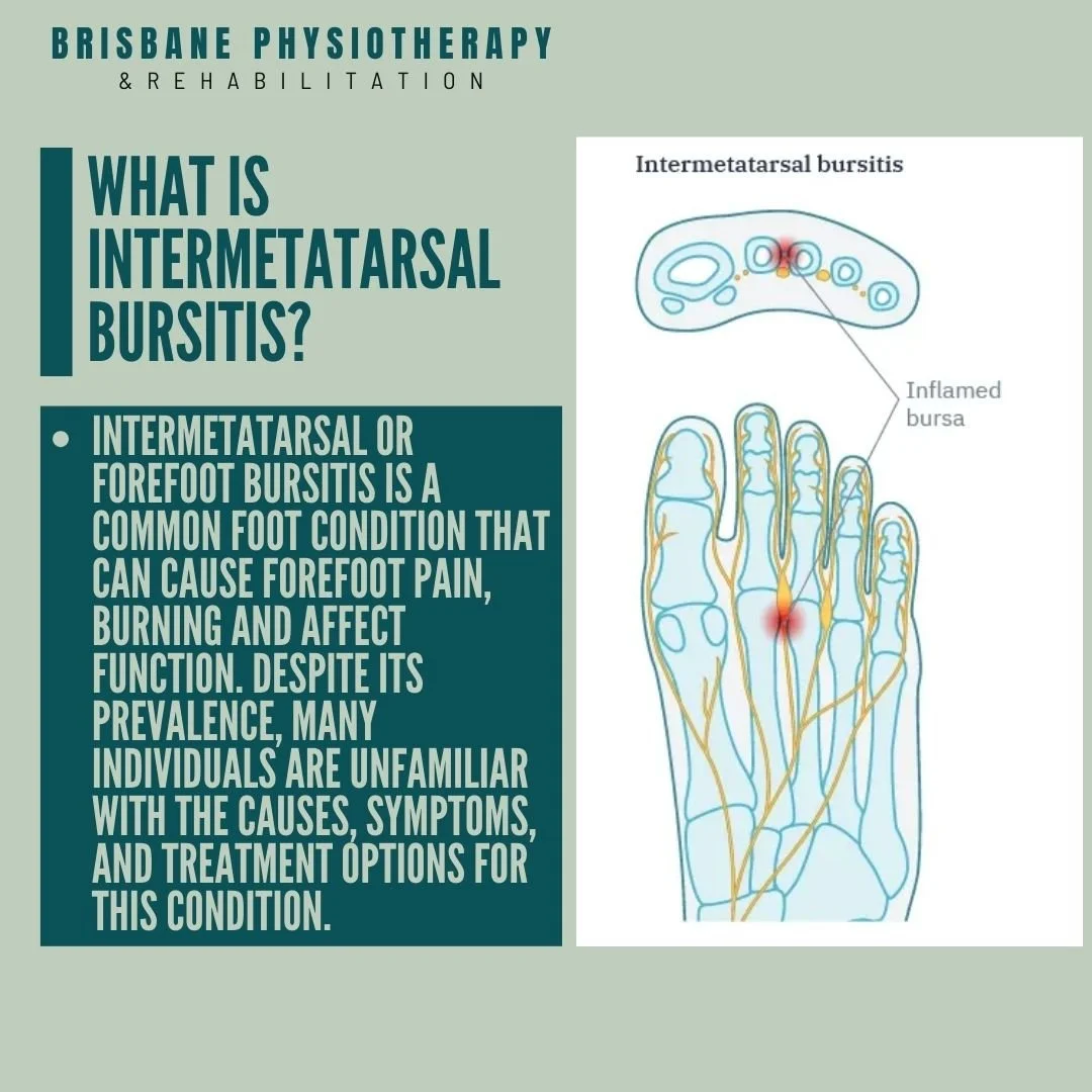 What Is Intermetatarsal Bursitis?