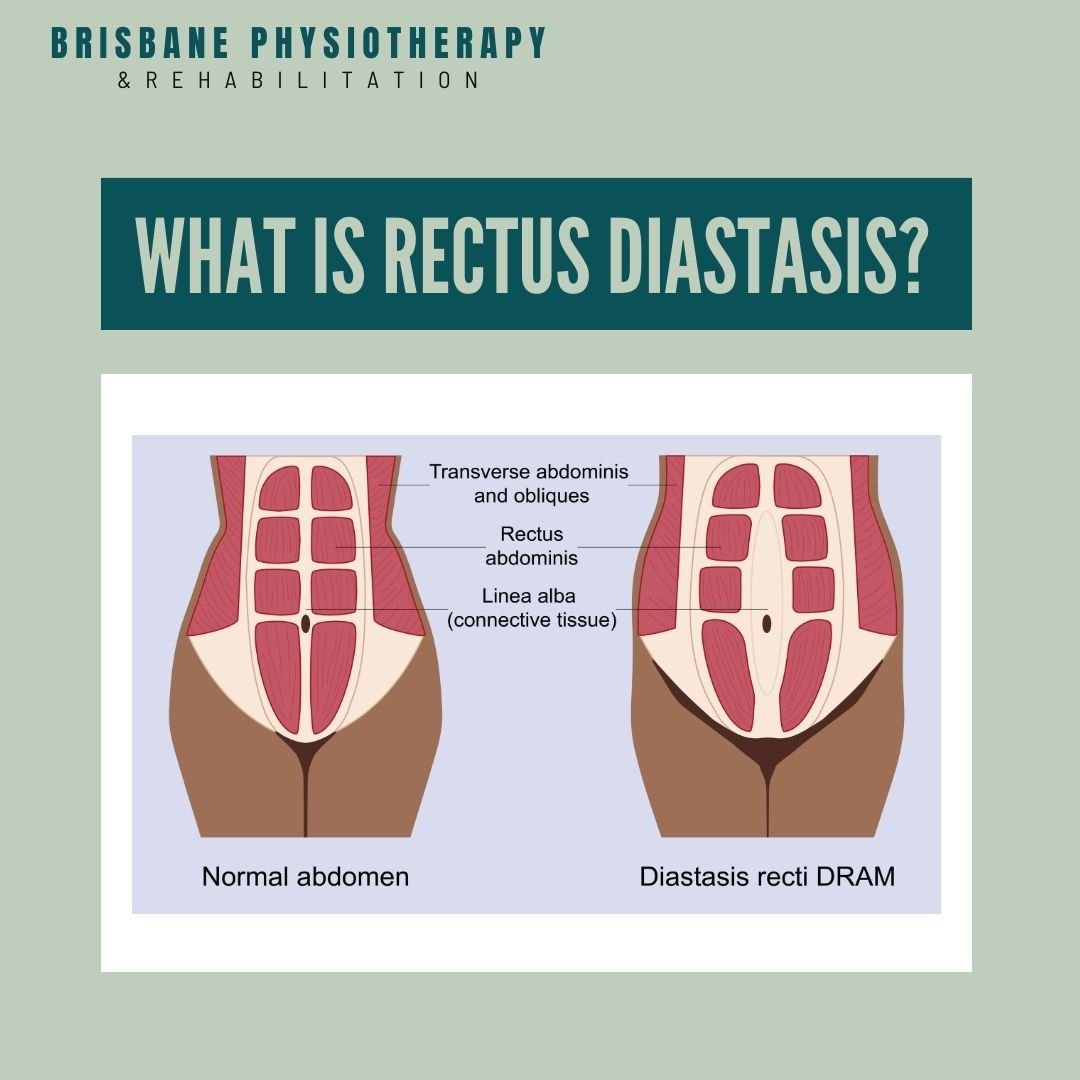 What is Rectus Diastasis?