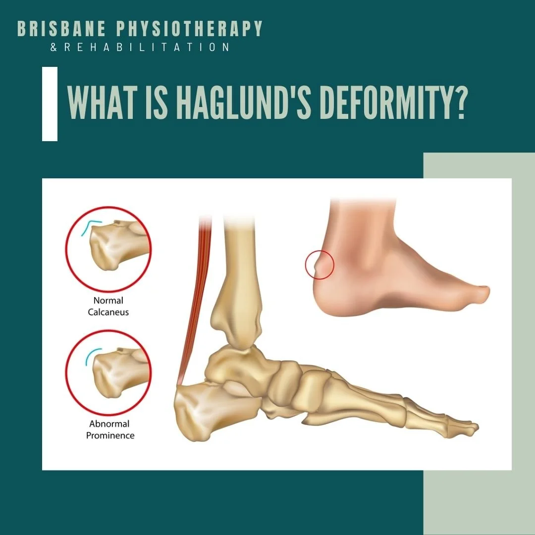 What is a Haglund’s Deformity?