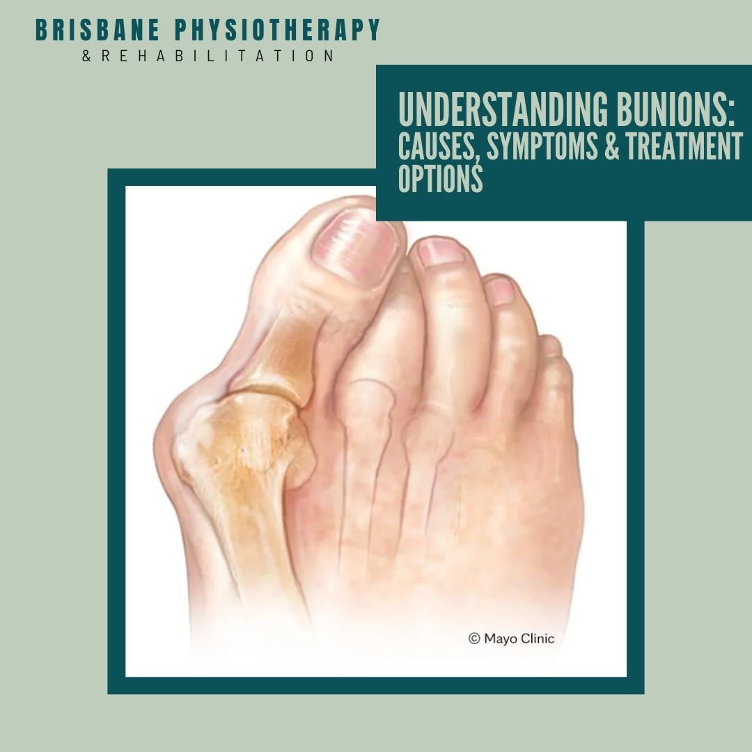 What are Bunions?

Bunions, medically termed hallux valgus, are bony protrusions that form at the base of the big toe due to misalignment of the joint. Genetics, ill-fitting footwear, foot structure, and inflammatory conditions like rheumatoid arthri