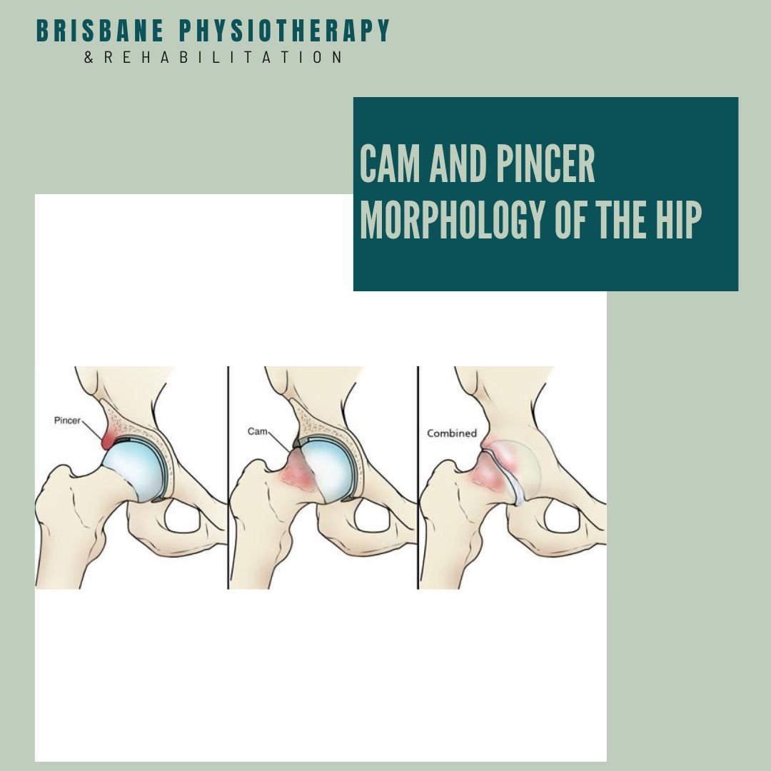 Cam and Pincer Morphologies of the Hip