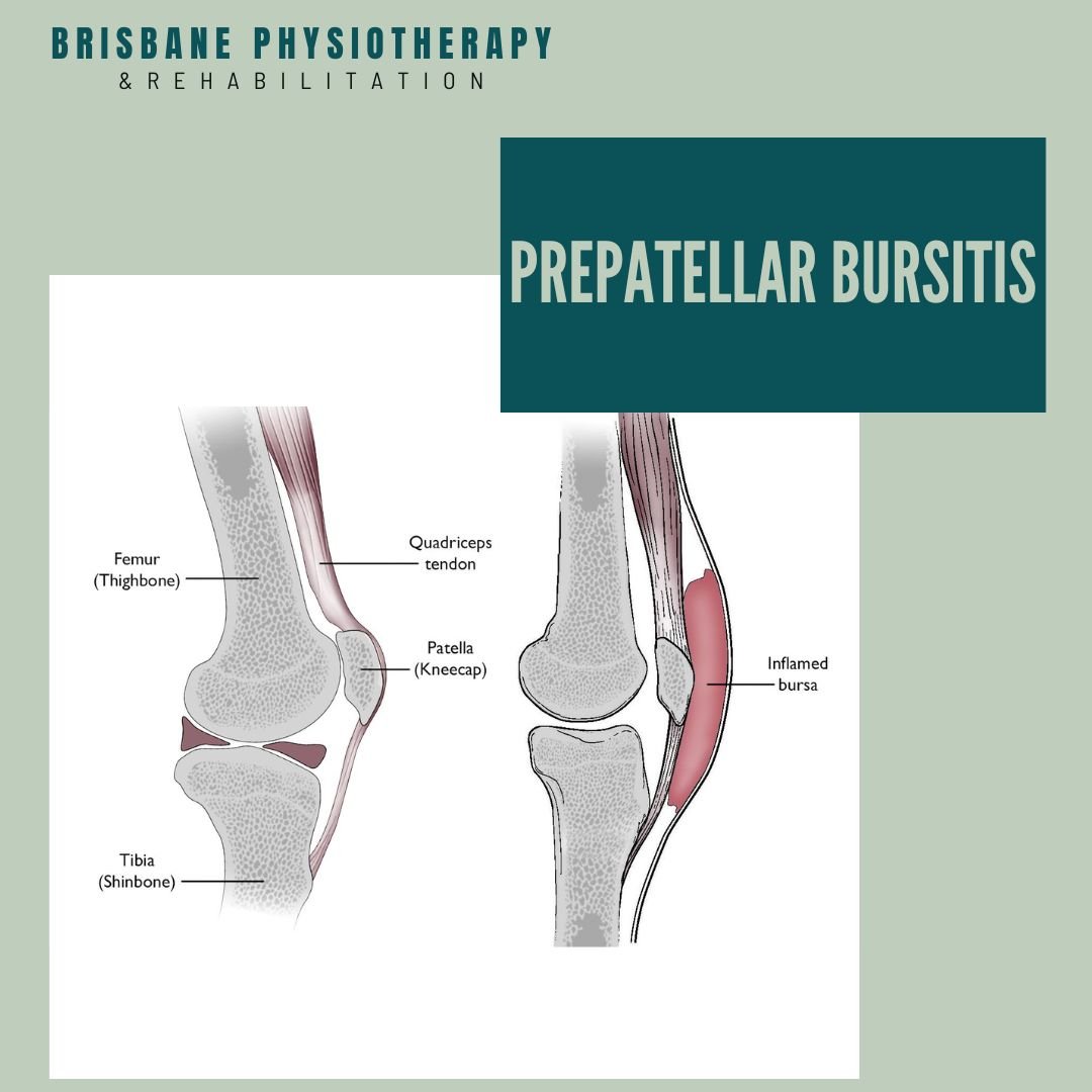 What is Prepatellar Bursitis?