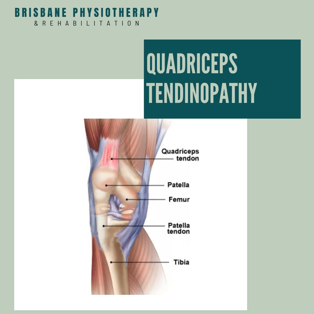 What is Quadriceps Tendinopathy?