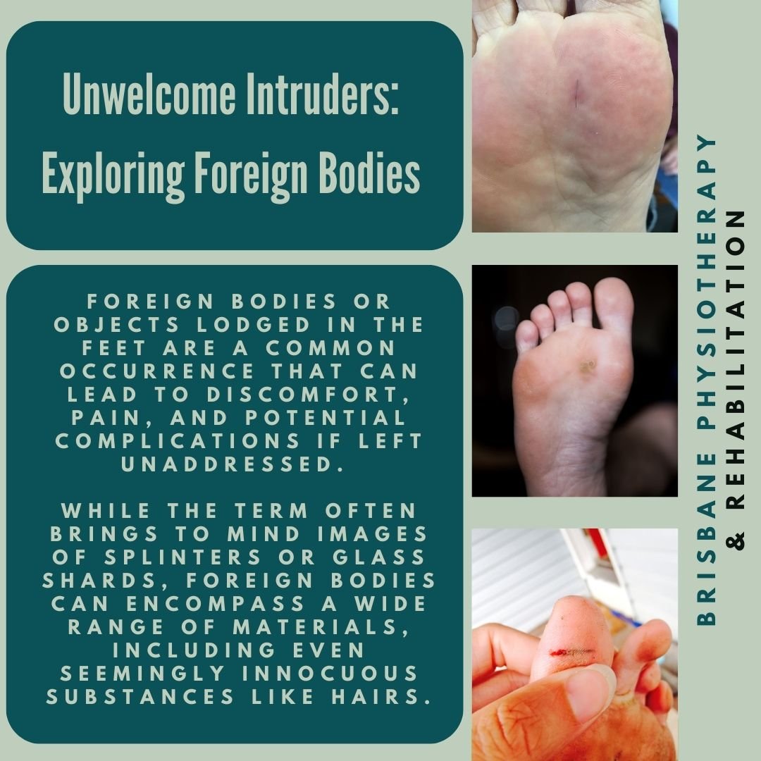Unwelcome Intruders: Exploring Foreign Bodies in the Feet