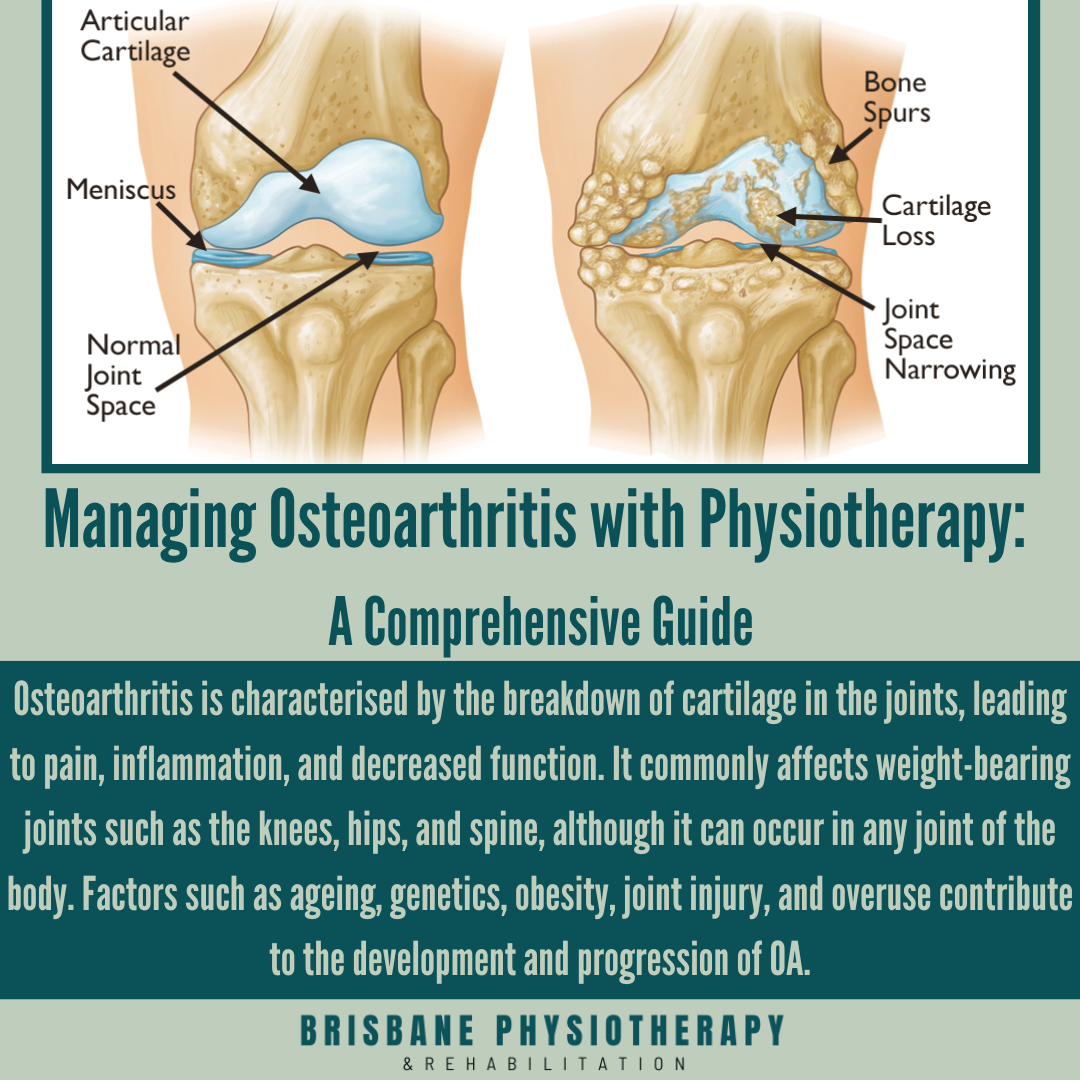 Managing Osteoarthritis with Physiotherapy