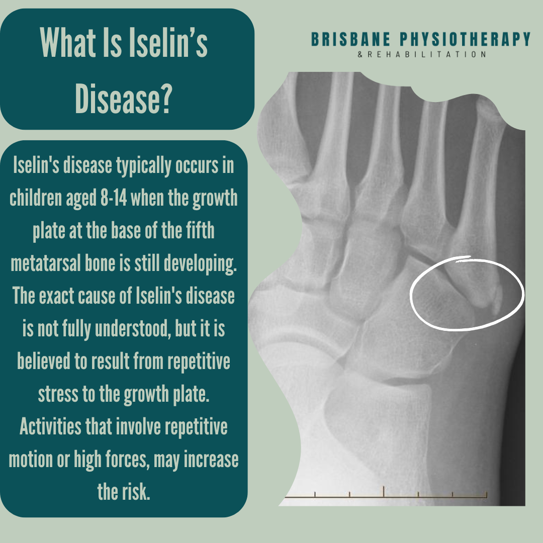 What Is Iselin’s Disease?