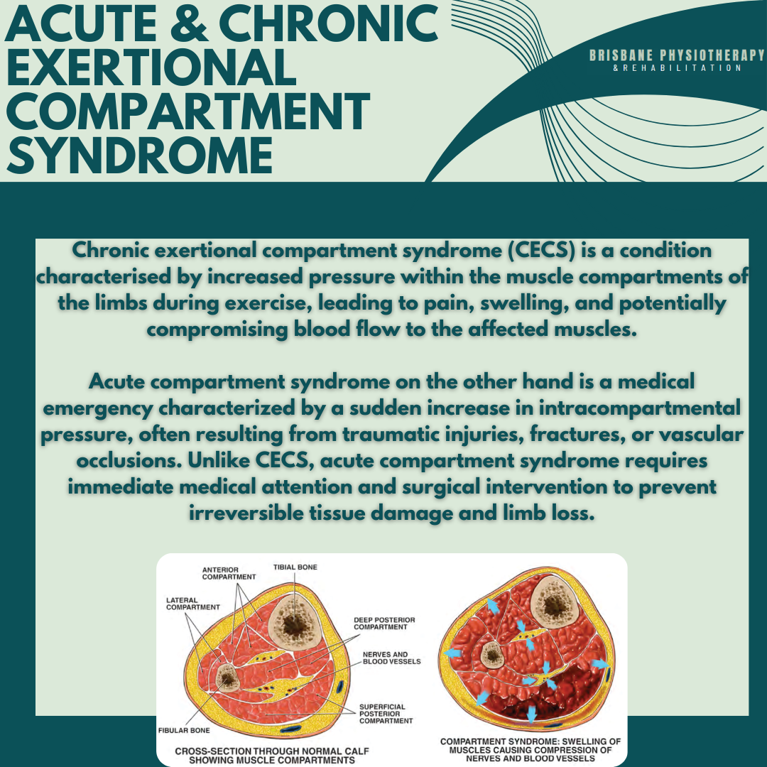 What is Acute and Chronic Exertional Compartment Syndrome (CECS)?