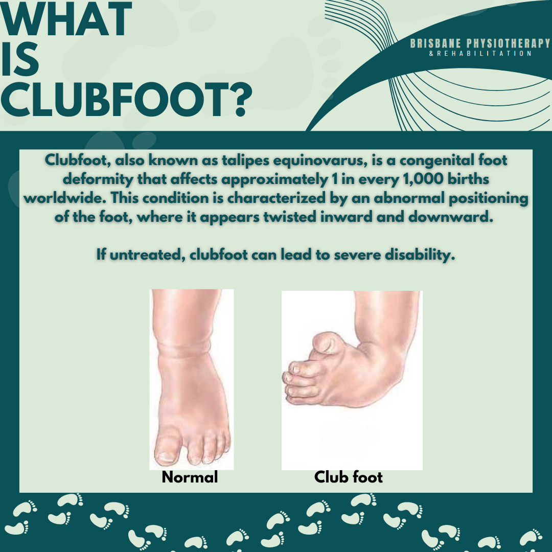 What is Clubfoot (Talipes Equinovarus)?