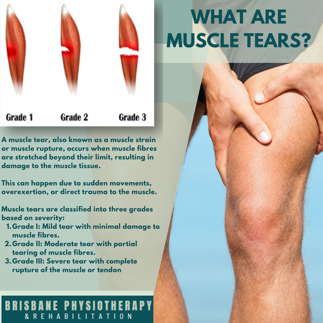 What are Muscle Tears?