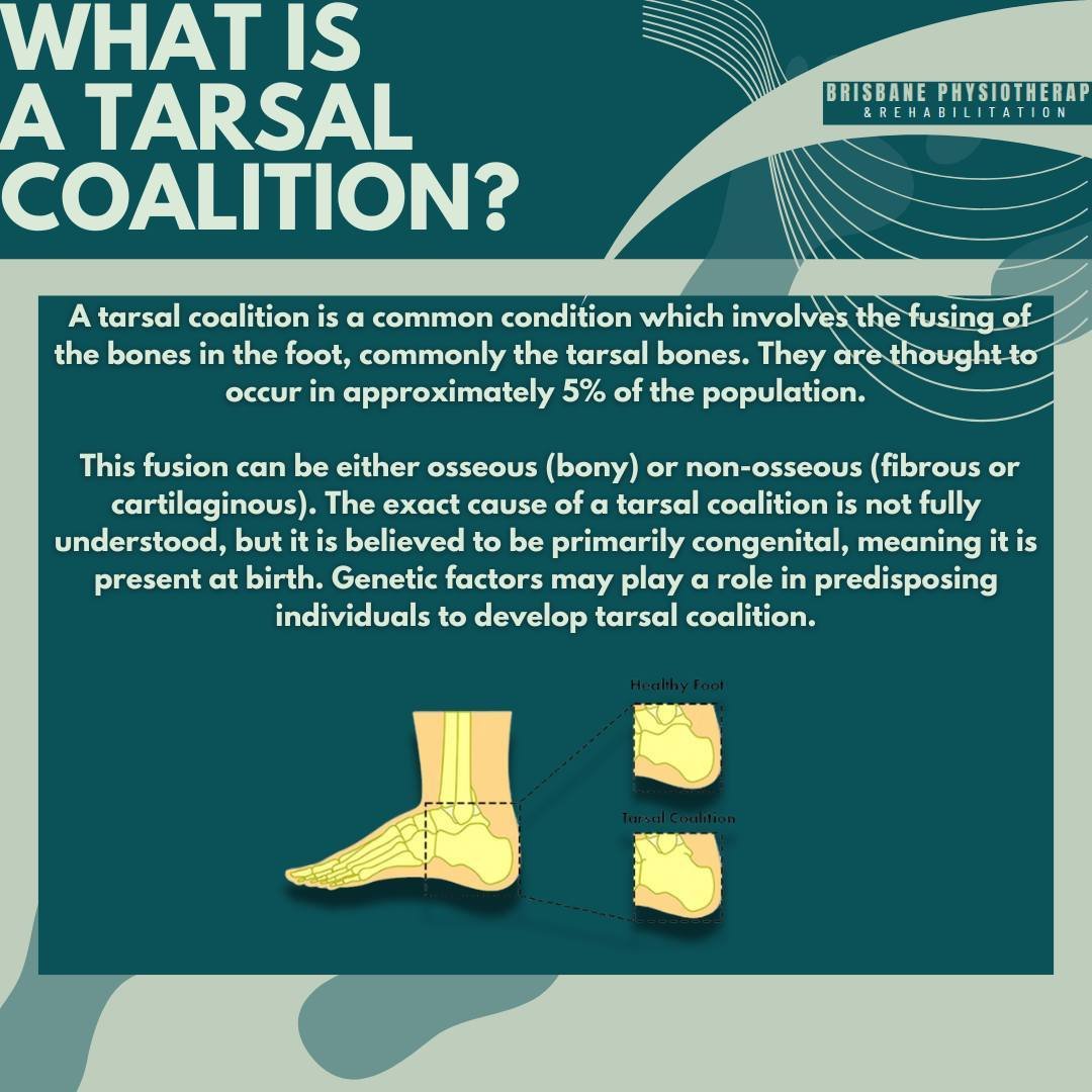 Understanding Tarsal Coalition

A tarsal coalition is a condition that involves the fusion of bones in the foot, particularly the tarsal bones, and affects approximately 5% of the population. This condition arises when two or more tarsal bones fail t