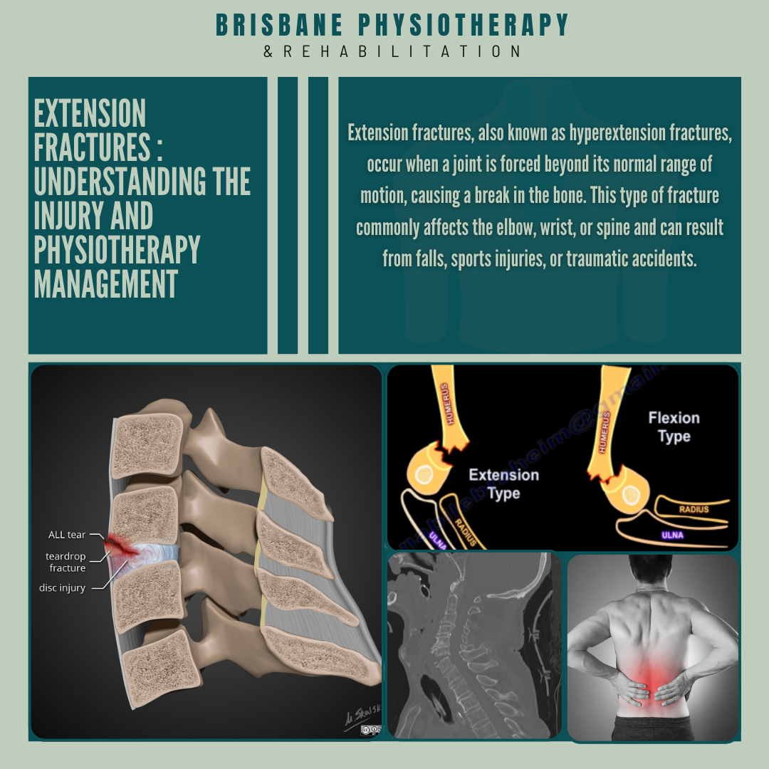 Extension Fractures