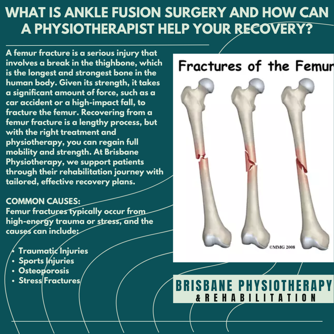 Femur Fractures