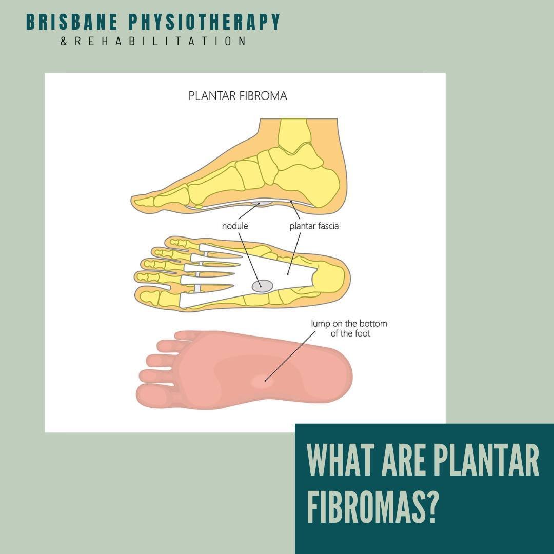 What Are Plantar Fibromas?

Plantar fibromas, also referred to as Ledderhose disease or plantar fibromatosis, are non-cancerous growths that develop within the plantar fascia, the thick tissue band along the bottom of the foot. These fibrous nodules 