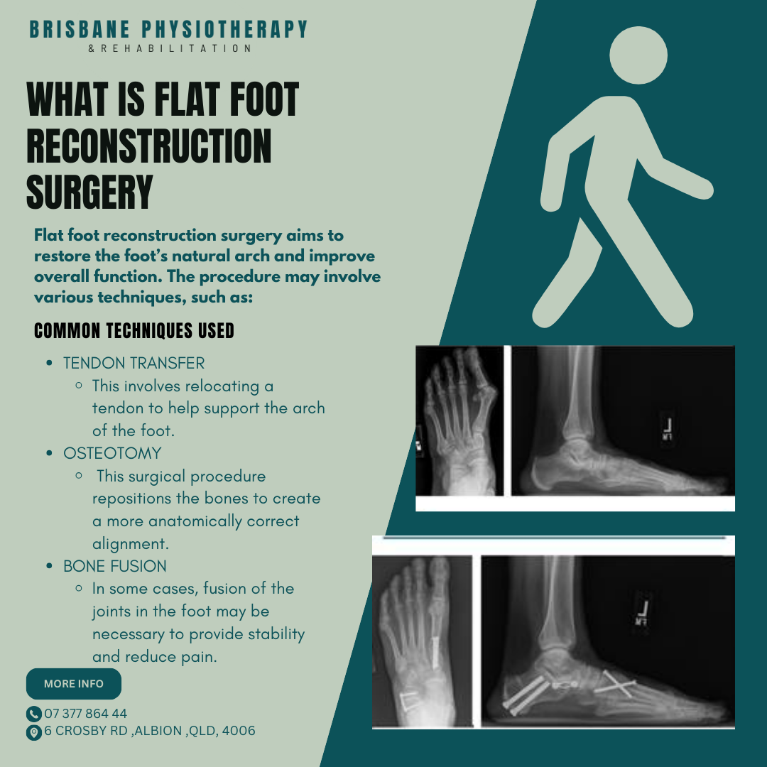 Flat Foot Reconstruction Surgery