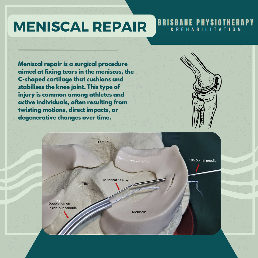 Meniscal Repair Surgery