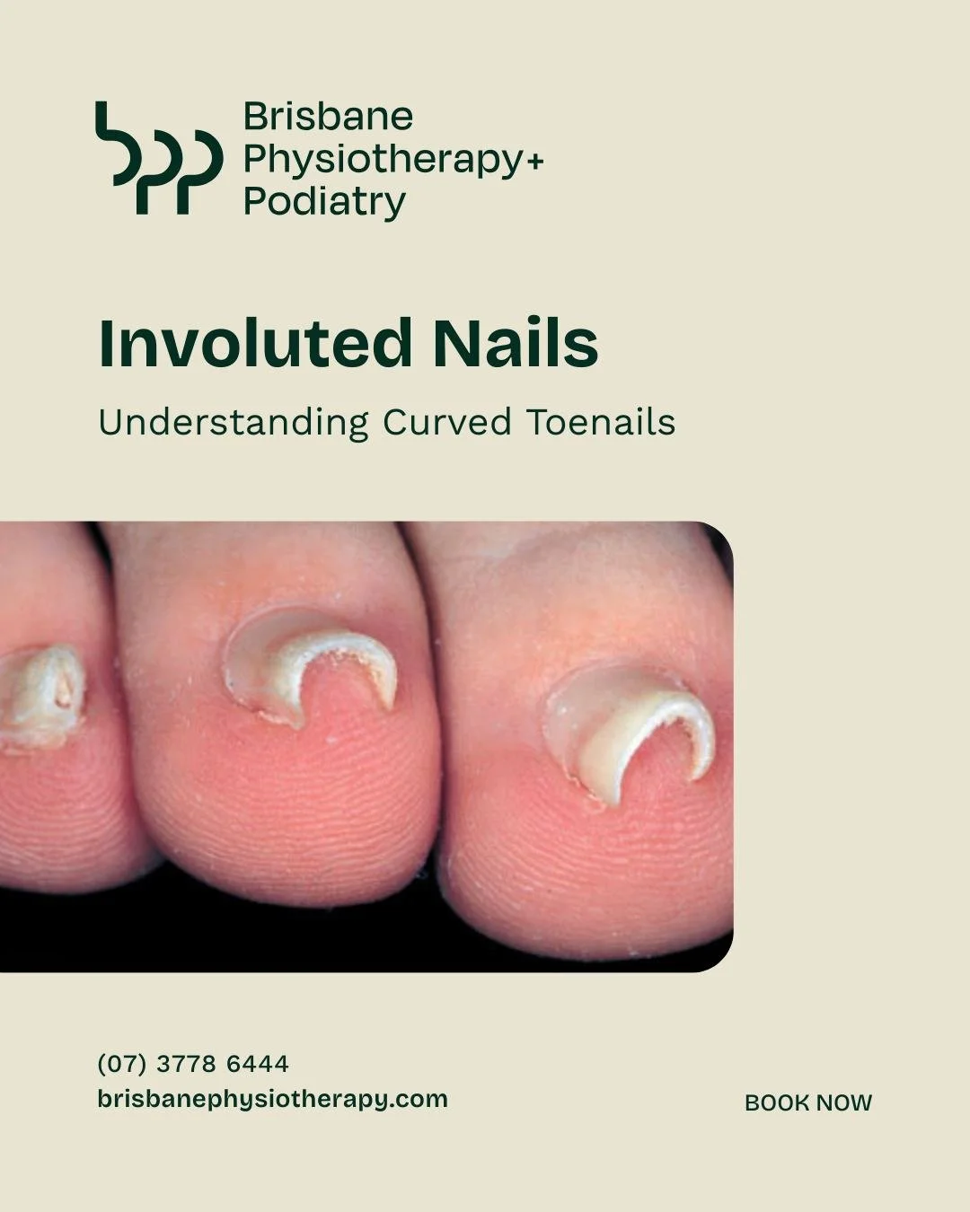 Involuted Nails
Curving toenails that dig into the skin can quickly turn from an annoyance into a painful problem. Known as involuted nails, this condition happens when the edges of the nail curl inward, causing pressure, discomfort, and sometimes i
