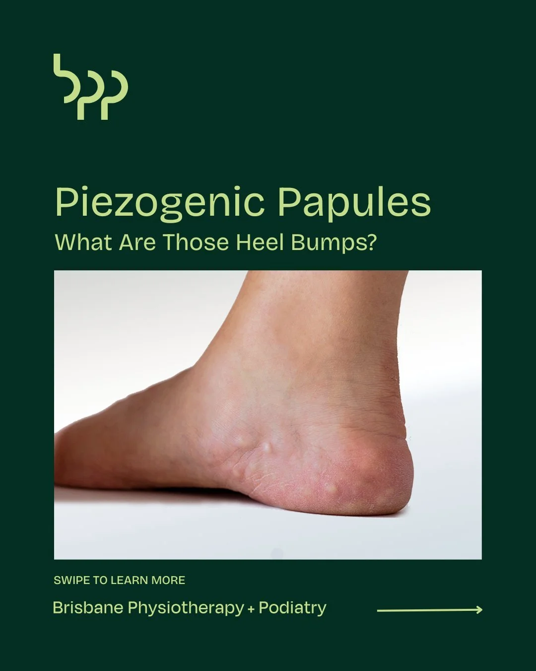 Piezogenic Papules

Ever noticed small, soft bumps appear on your heels when you stand? These are called piezogenic papules. While usually harmless, they can sometimes cause pain, tenderness, or irritation, especially if compressed by shoes or activi