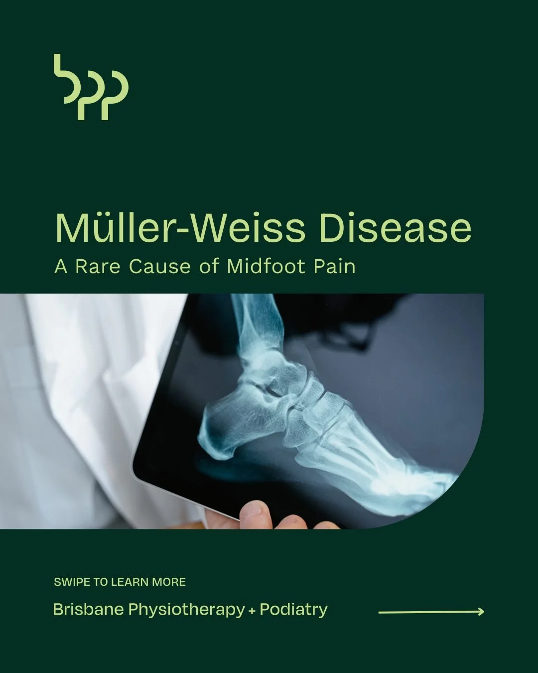 M&uuml;ller-Weiss Disease

Persistent midfoot pain can be frustrating, especially when it affects walking, standing, or everyday activities. One possible cause is M&uuml;ller-Weiss disease, a rare condition that affects the navicular bone in the midf