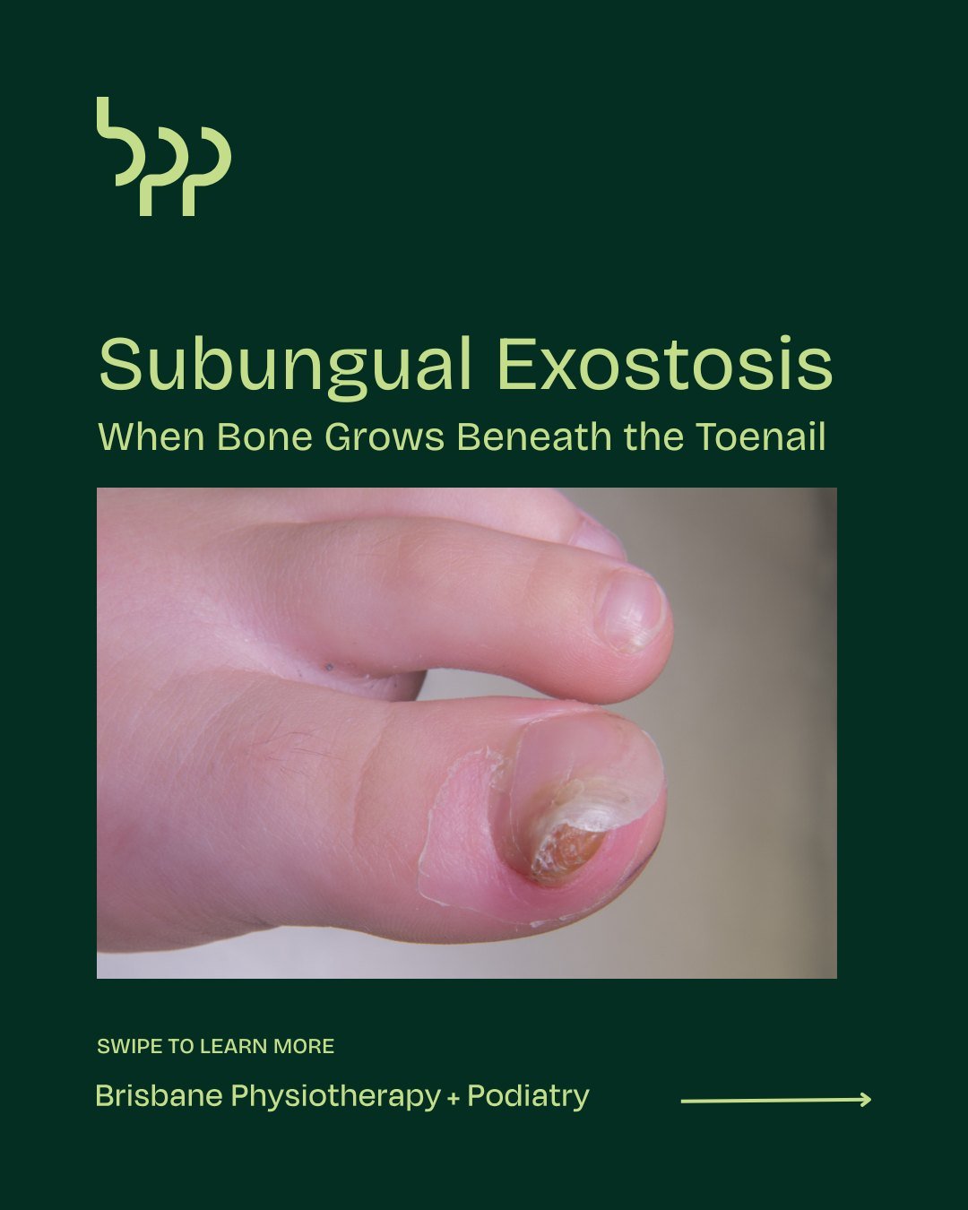 Subungual Exostosis: Painful Bump Under Your Toenail

Have you noticed a hard, painful bump forming beneath your toenail? This could be a subungual exostosis, a small, benign bone growth that most commonly affects the big toe. While not usually dange