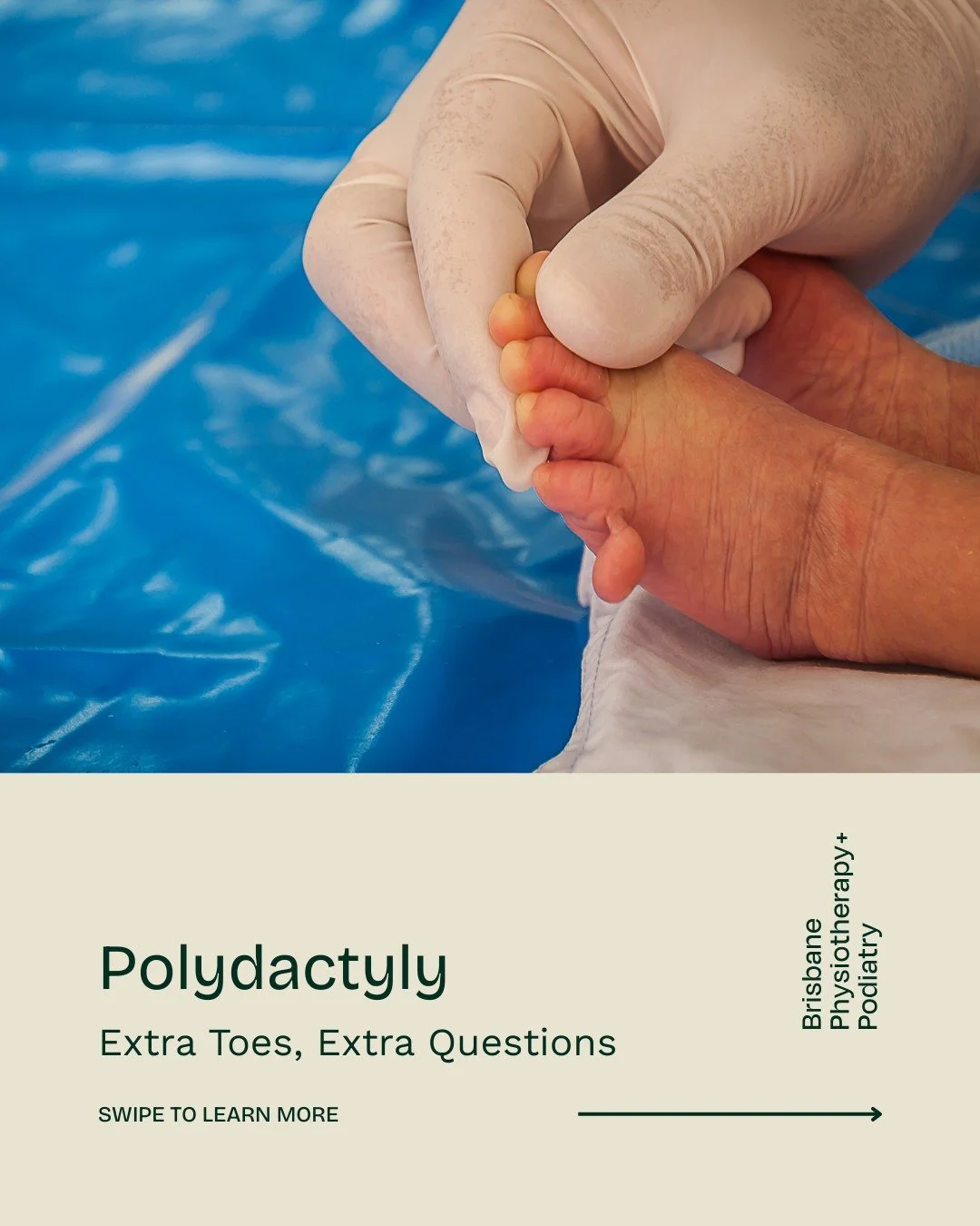 Polydactyly: Extra Toes or Fingers and What to Know

Being born with extra toes or fingers, known as polydactyly, is more common than many realise. For some, the extra digit is small and harmless, but in other cases, it can affect walking, balance, o