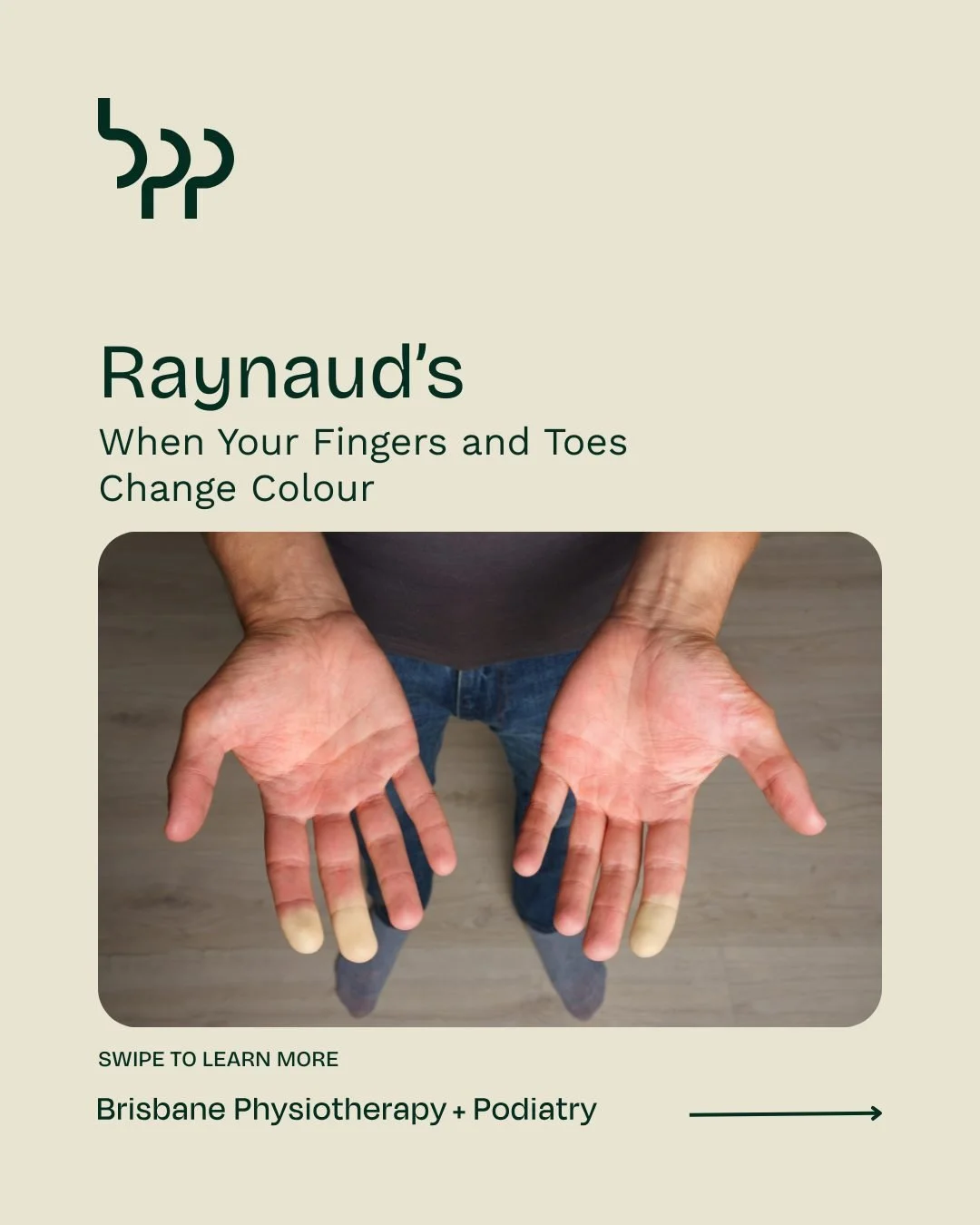 Raynaud&rsquo;s: When Your Fingers and Toes Change Colour

Do your fingers or toes turn white, blue or red in the cold? This could be Raynaud&rsquo;s, a condition where small blood vessels spasm and limit circulation to the extremities. Episodes are 