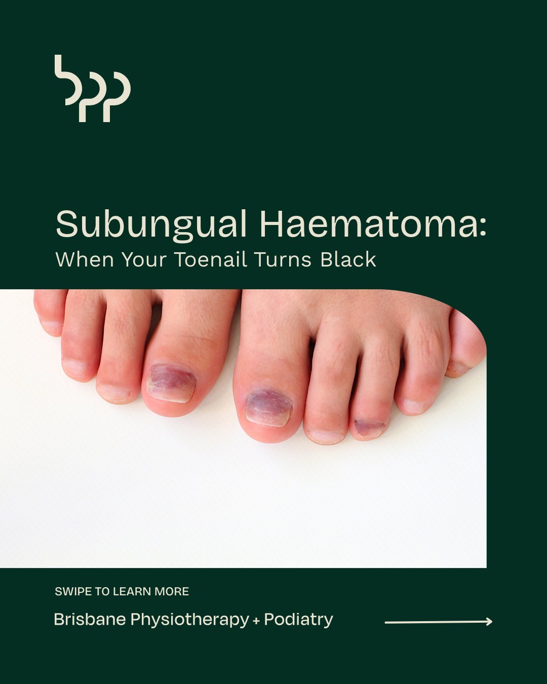 Subungual Haematoma: When Your Toenail Turns Black

Noticing a black or bruised toenail after stubbing your toe, dropping something heavy, or long runs can be alarming. This is often a subungual haematoma, where blood collects under the nail due to t