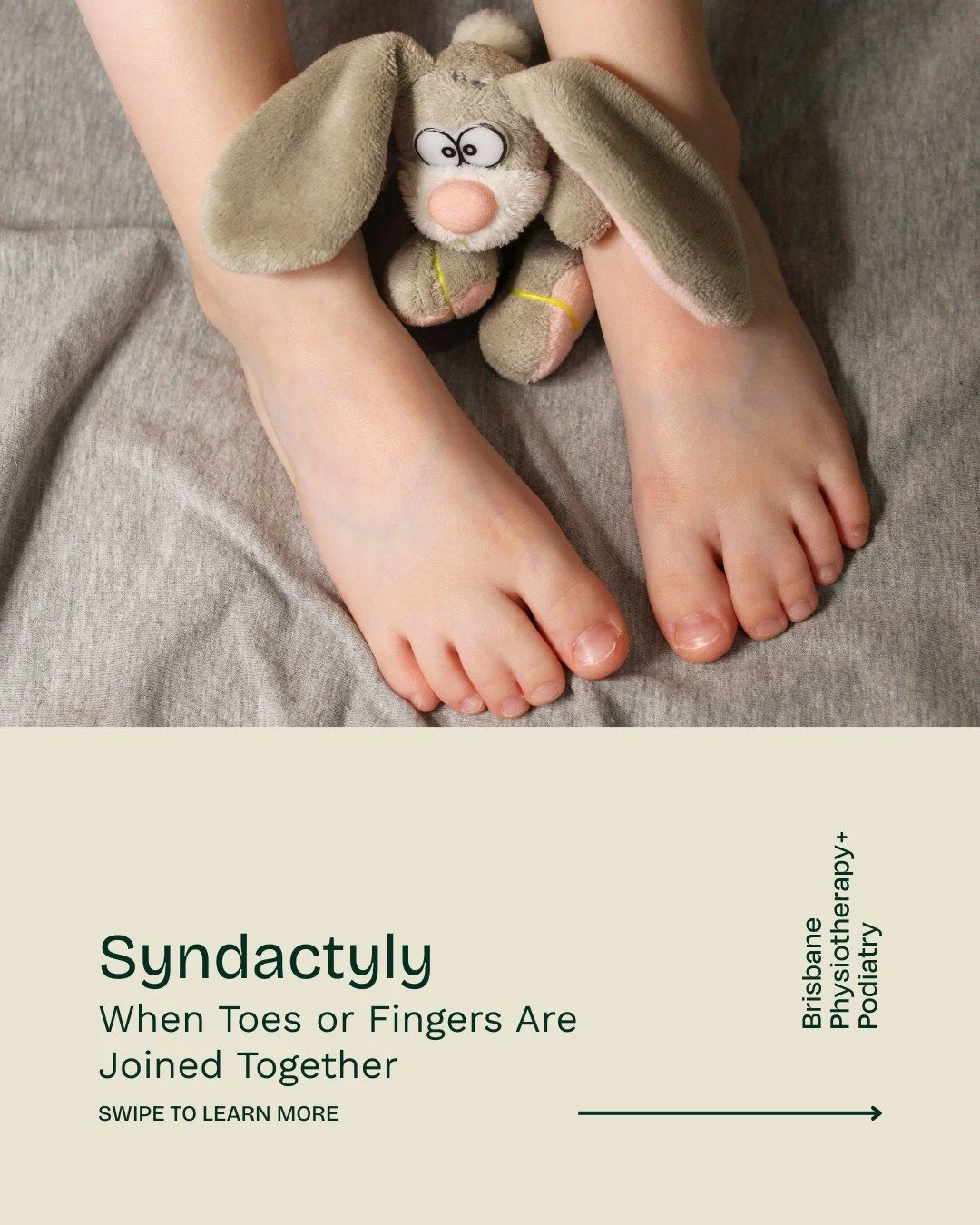 Syndactyly: When Toes or Fingers Are Joined Together

Syndactyly is a condition where two or more toes or fingers are fused, either partially or completely. It develops in the womb when the digits don&rsquo;t fully separate and occurs in about 1 in e