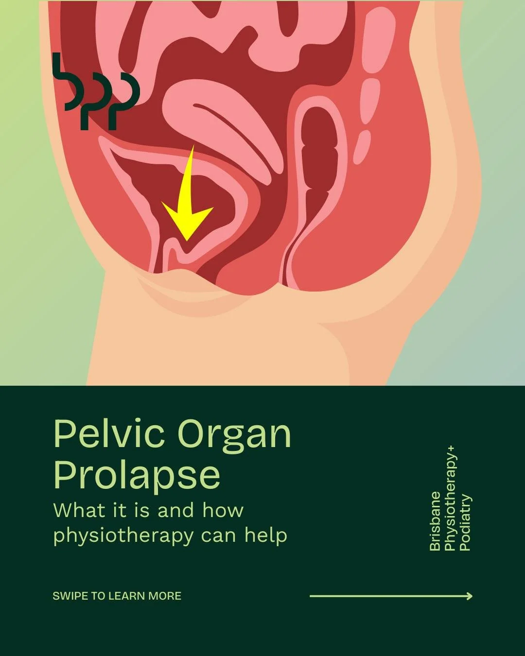 Pelvic Organ Prolapse: What It Is and How Physiotherapy Can Help

Pelvic organ prolapse is a condition where one or more pelvic organs, such as the bladder, uterus or rectum, descend into the vaginal space due to weakened pelvic floor muscles and sup