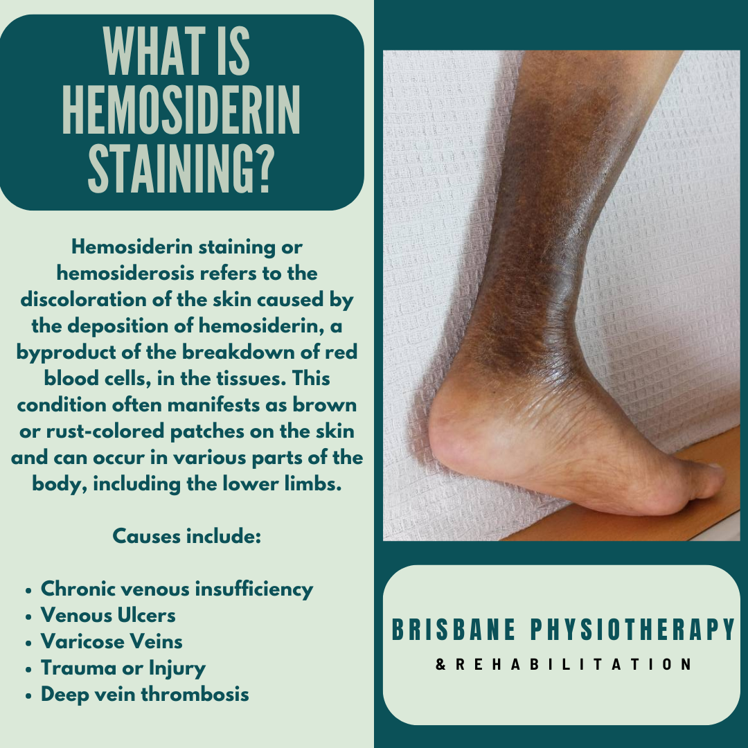 Hemosiderin Staining Venous Staining Hemosiderosis Pigmentation 