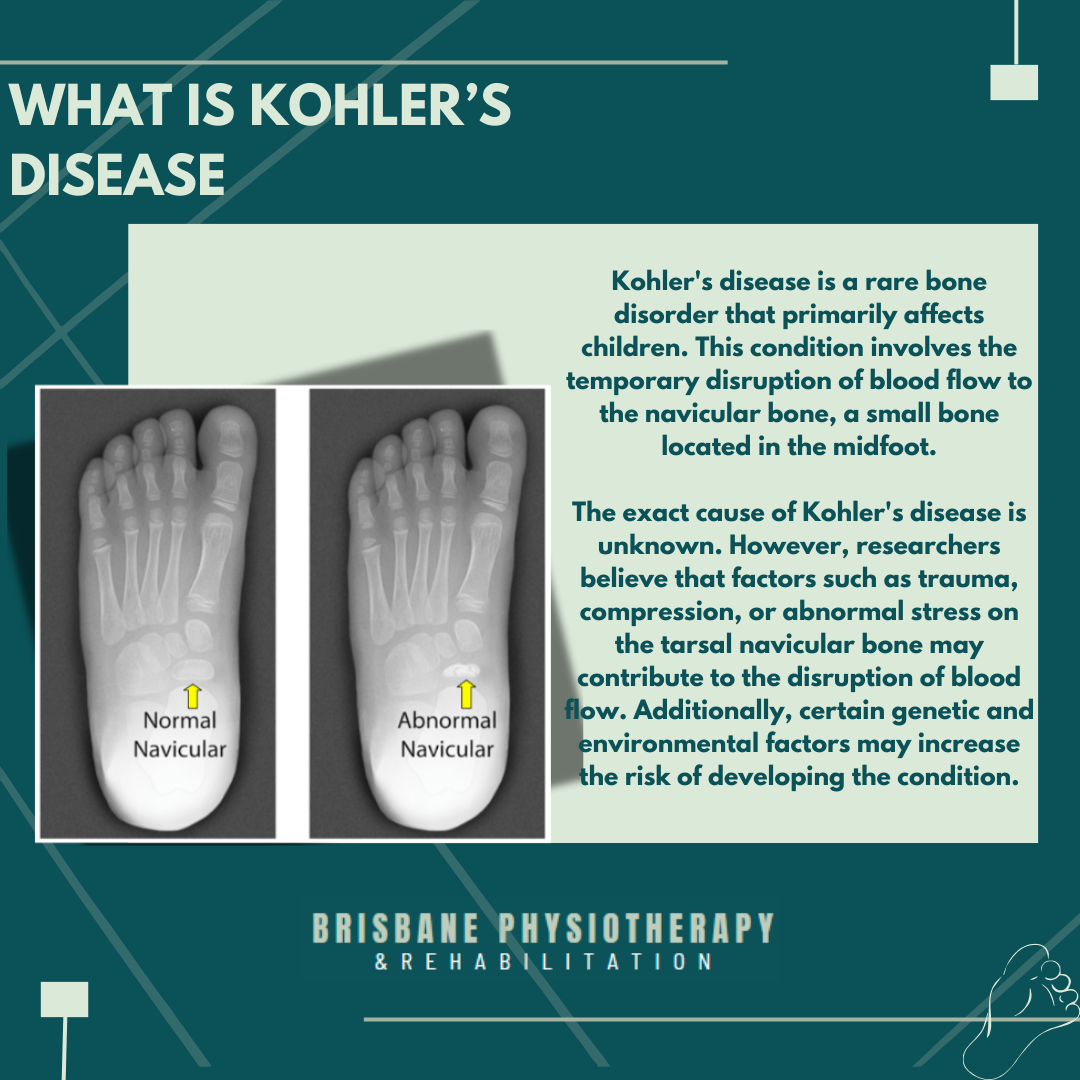 what-is-kohler-s-disease-brisbane-physiotherapy-podiatry