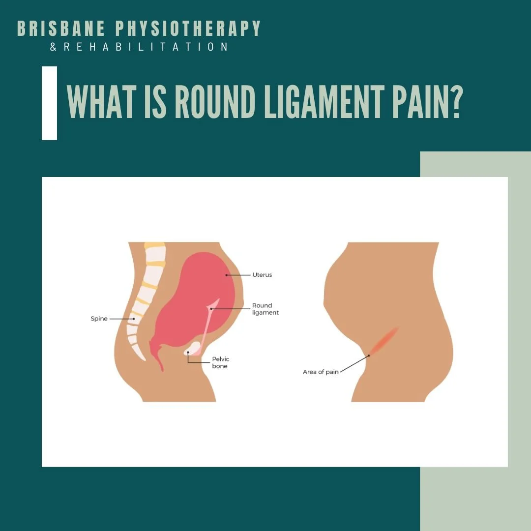 What is Round Ligament Pain? Brisbane Physiotherapy